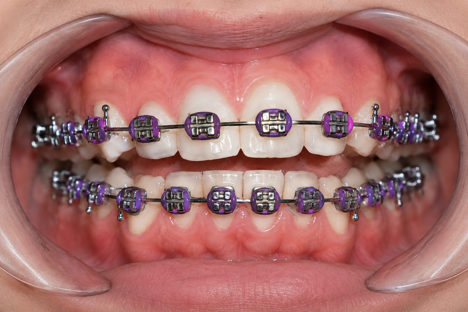 Realistic white teeth with purple orthodontic ligatures, shown in a wider clinical view
